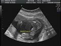 The Baby Boy...