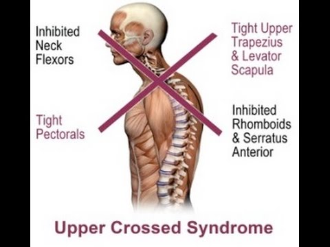 how to treat upper crossed syndrome