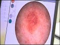 SIAscope Skin Cancer Screening