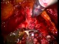 Ralrp - Athermal Division And Selective Suture Ligation Of The Dorsal Vein