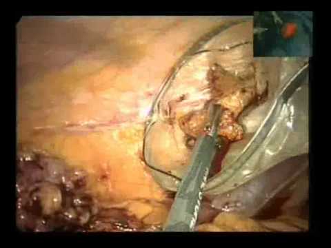 how to transplant staghorns