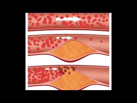 how to treat ldl cholesterol