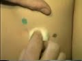 asthma cards - removing the balls - finally  Asthma Massage
