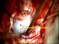 Dumbell NEUROFIBROMA cervical spine C1-C2-microsurgical removal-dr suresh dugani/HUBLI//INDIA