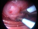parathyroidectomie video assist�e montpellier