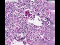 Histopathology Spleen --Gaucher disease
