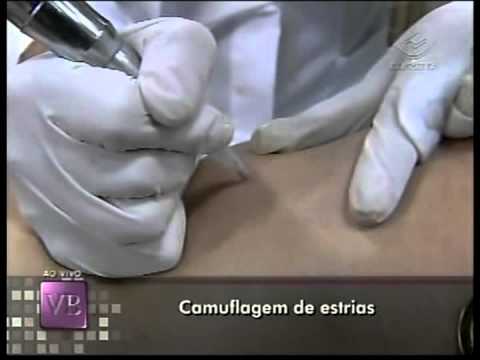 Vanessa Silveira - Micropigmentação de Estrias - tratamento eficaz