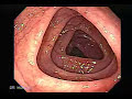video-colonoscopy-displaying-a-colon-cancer.html