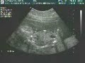 ecografia del dorian con 19 semanas y 5 dias de gestacion ecografia del dorian con 19 semanas y 5 dias de gestacion