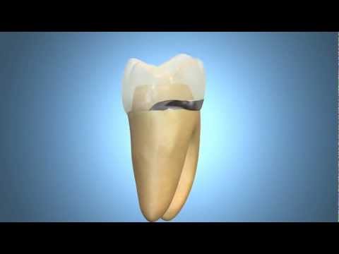 how to dissolve orthodontic cement
