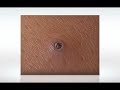背部粉瘤手術 2011/01/05