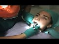 Torus mandibular UVB Torus mandibular UVB