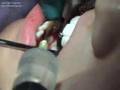Torus mandibular UVB