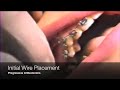 Initial Wire Placement