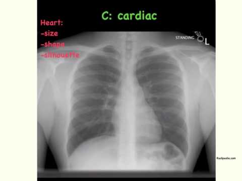 how to read chest x ray