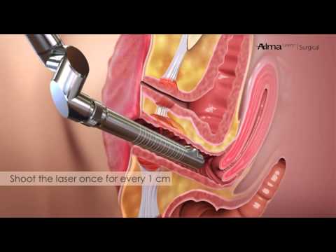 vaginal