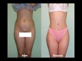 Dr. Hector Maldonado-Cirugia Estetica, Plastica y Reconstructiva antes y despues