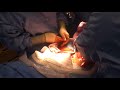 Domokos Kiara birth by caesarean section