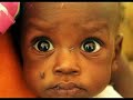 DARFUR MALNUTRITION