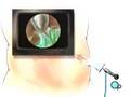 PreOp® Patient Education: Laparoscopy Diagnostic Surgery