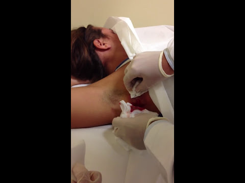 how to drain armpit cyst
