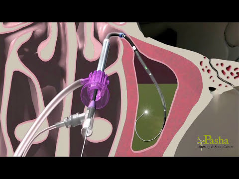 how to relieve aerosinusitis