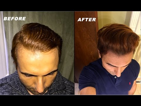 how to cure receding hairline