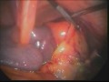 Laparoscopic cholecystectomy in a man with Situs Inversus