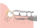 extraction of lower wisdom tooth - cartoon - without blood