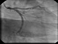 intracardiac-cathete