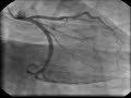 intracardiac-cathete