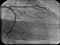 intracardiac catheter #1