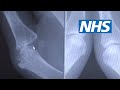 Arthritis foods to avoid