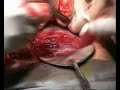 Showing Cesarean Section Operation
