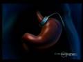 Lapband in the news- Mercy Bariatrics Videos-Adelaide Obesit