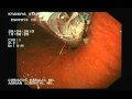 Esophyx - Endoscopic Fundoplication, Part 1.