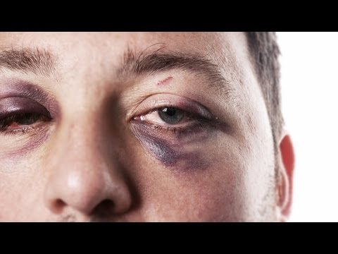 how to get rid o f a black eye