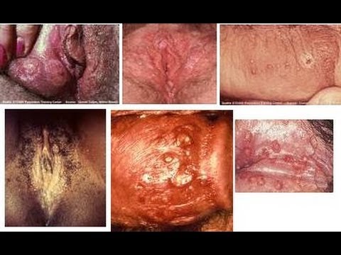 how to cure hsv 2
