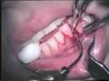videos de dental laser operation