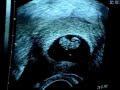Semilla se presenta en Sociedad-Ecografia 7 semanas) Semilla se presenta en Sociedad-Ecografia 7 semanas)