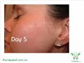 Skin peel and face peel that is salon quality you do yourself at home for a fraction of the cost Skin peel and face peel that is salon quality you do yourself at home for a fraction of the cost