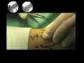 Kapandji pinning of colles fracture