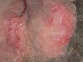 Genital Herpes Simplex Signs and Symptoms