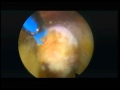 Selective Endoscopic Discectomy - Part 2 - 04-11-2012