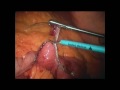 Gastric Bypass part A. Dr. Hadar Spivak, Houston, Texas.