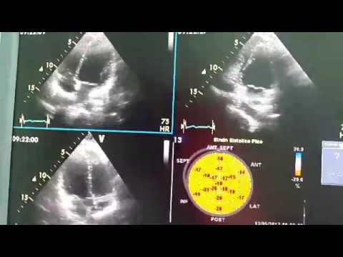 Prolapso valvular mitral. Dr. Luciano Pereira