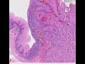 Histopathology Esophagus--Squamous cell carcinoma