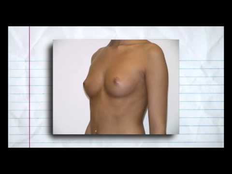 how to relieve bloating after breast augmentation