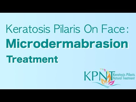 how to cure kp on face