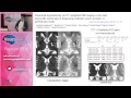 Neurology up to Date 2015 Mar Tintoré Neurology up to Date 2015 Mar Tintoré